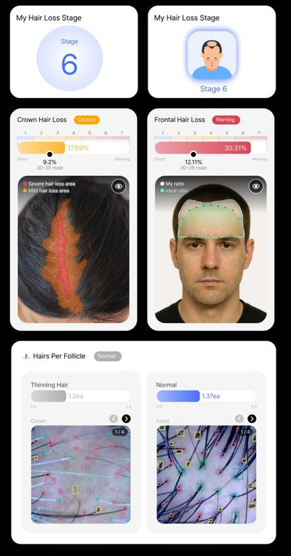 Wireless Ai Scalp Scanner